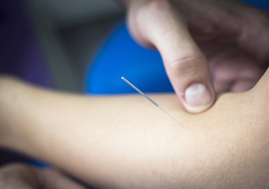 Acupuncture | Complete Health | Chiropractic & Wellness Clinic | SW Calgary