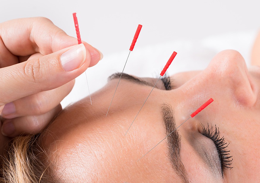 Acupuncture | Complete Health | Chiropractic & Wellness Clinic | SW Calgary