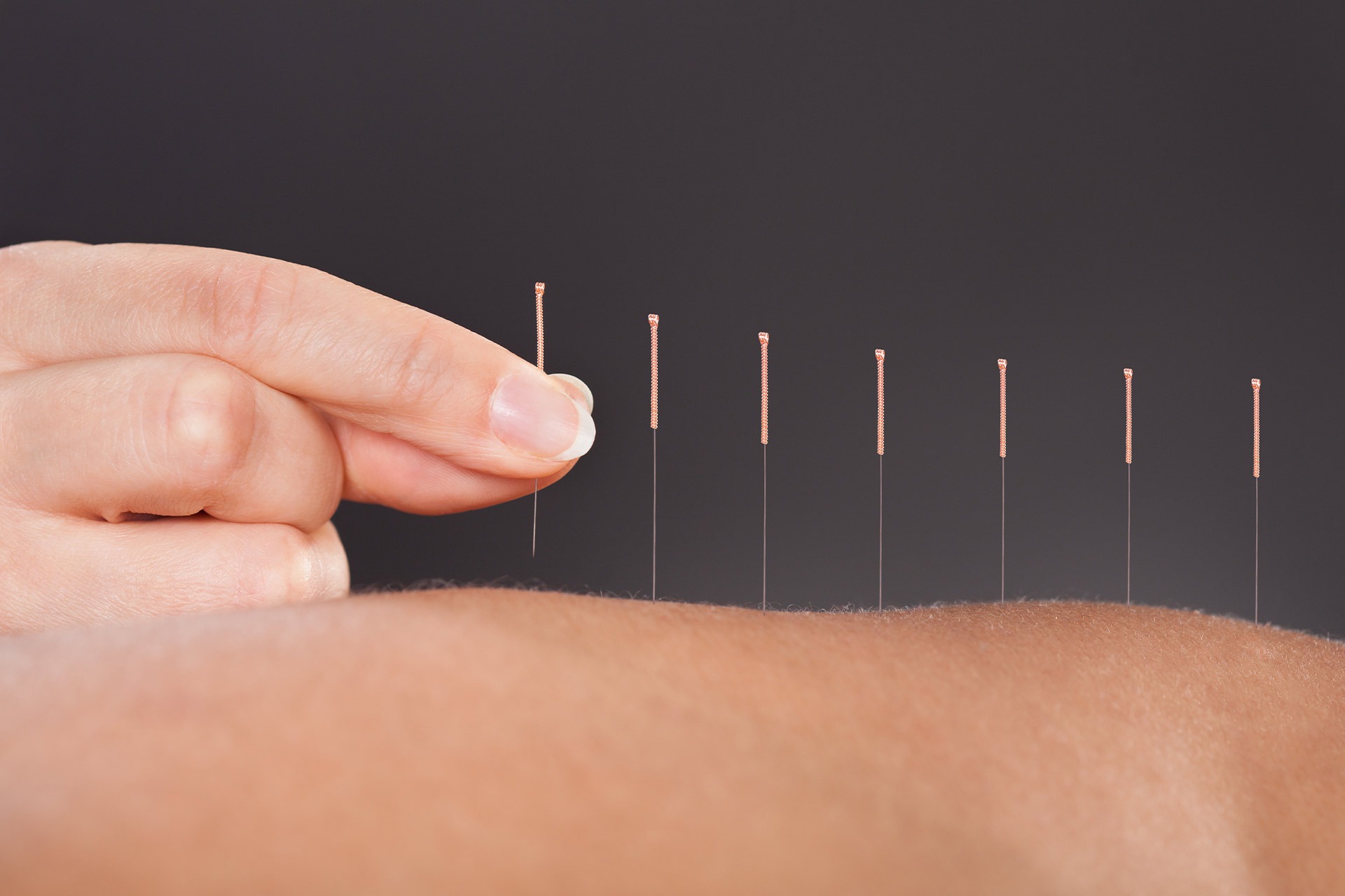 What is the goal of acupuncture | Complete Health | SW Calgary Chiropractor